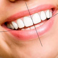 RĂNG SỨ LAVA 3M PLUS